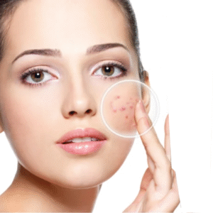 Acne Gel