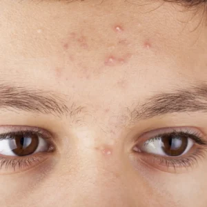 Acne